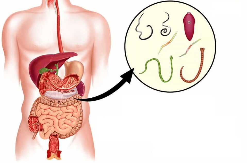 Worms and worms in the gastrointestinal tract