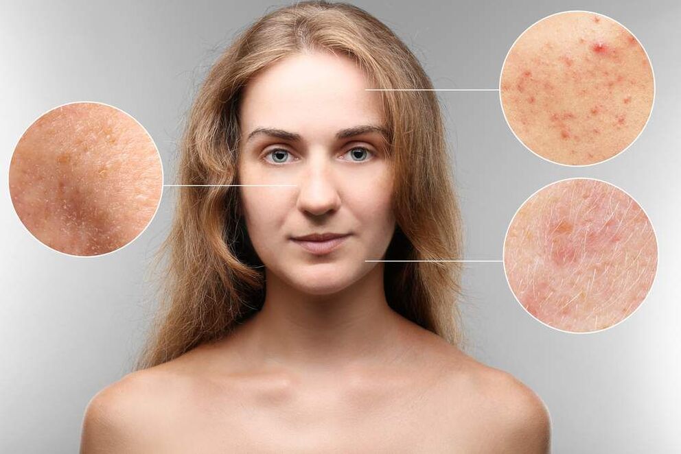 Rash on face due to parasites